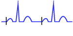 Stimulation auriculaire du pacemaker