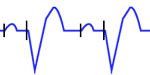Pacemaker with Dual-Chamber Pacing