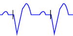 Pacemaker with Ventricular Pacing