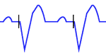 Marcapasos con estimulación Ventricular