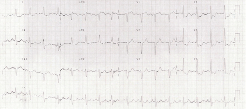 Electrocardiograma de Examen MIR 2010
