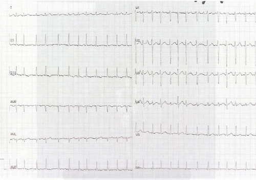 Electrocardiograma de Examen MIR 2011