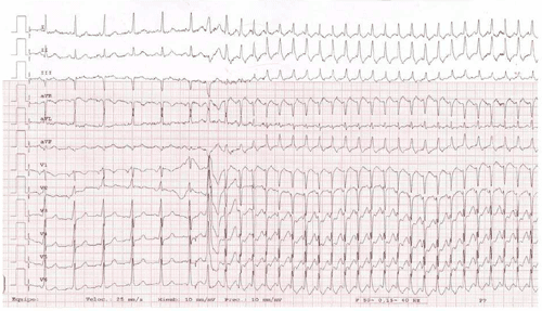 Electrocardiograma de Examen MIR 2013