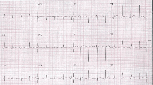 Electrocardiograma de Examen MIR 2015