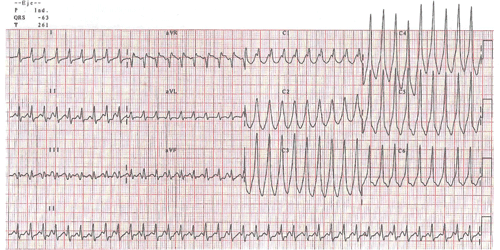 Primer Electrocardiograma del Examen MIR 2017