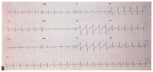 Tercer Electrocardiograma del Examen MIR 2017