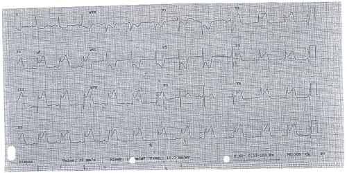 Tercer Electrocardiograma del Examen MIR 2017