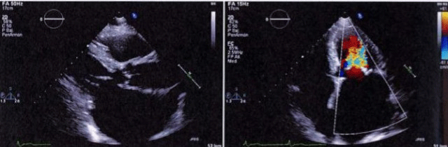 Cuarta Imagen de Cardiología del Examen MIR 2018