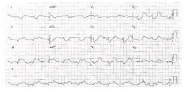 Sexta Imagen de Cardiología del Examen MIR 2018