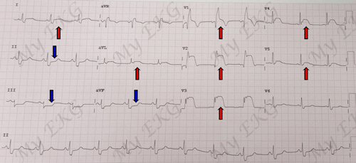 Infarctus aigu par Occlusion proximale de l'artère interventriculaire antérieure