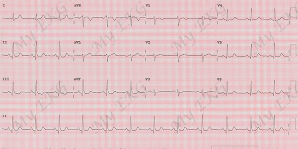 Normal Q Wave