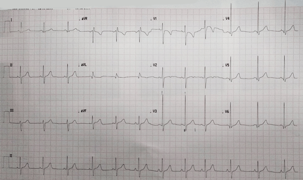 Eletrocardiograma da Comunicação Interatrial tipo Ostium Primum</i>