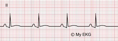 Electrocardiogram of Stage 2 of Acute Pericarditis