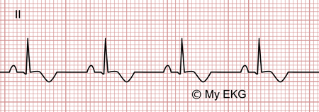 Électrocardiogramme de péricardite aiguë, phase 3