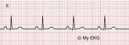 Electrocardiogram of Stage 4 of Acute Pericarditis