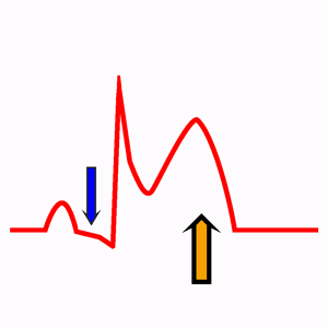 Acute Pericarditis on the Electrocardiogram