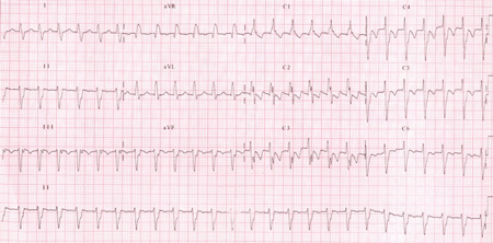 Posterior Fascicular Ventricular Tachycardia