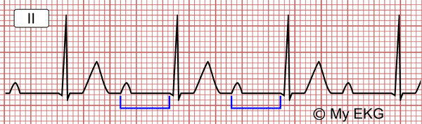 Pr Interval