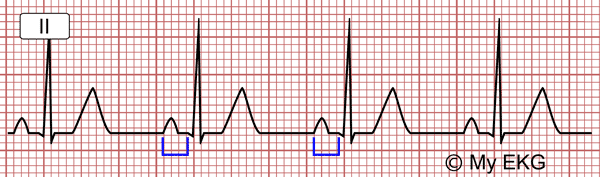 Normal PR Interval