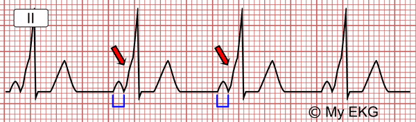 Wolff-Parkinson-White with Short PR Interval