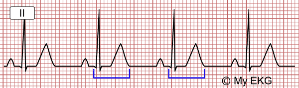 Normal QT Interval