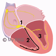 Right Bundle Branch Block, RBBB