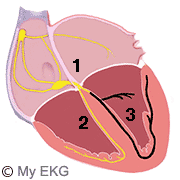 Left Bundle Branch Block (LBBB)