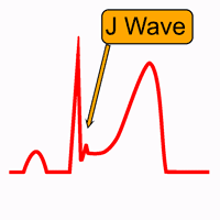 Padrão de Repolarização Precoce