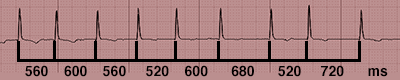 Ritmo Cardiaco Irregolare