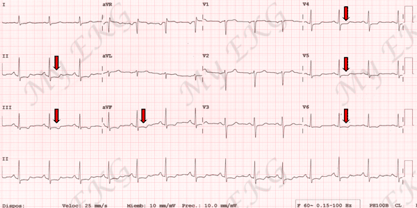 Electrocardiogram of Non-ST-Elevation Acute Coronary Syndrome, NSTE-ACS