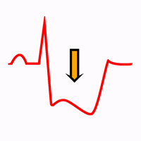 Syndrome coronarien aigu sans sus-décalage du segment ST