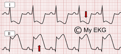 Elévation du segment ST avec une dépression réciproque du segment ST