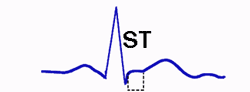 ST Segment