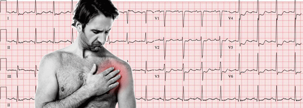 Síndrome Coronariana Aguda no Eletrocardiograma