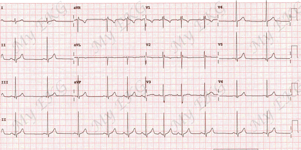 Electrocardiogram of Respiratory Sinus Arrhythmia