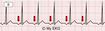 Électrocardiogramme d'une Tachycardie auriculaire