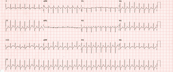 Atrioventricular Nodal Reentrant Tachycardia, AVNRT