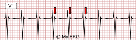 Electrocardiogramme de la tachycardie intra-nodale typique