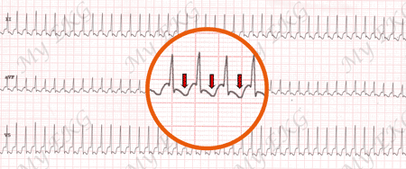 Eletrocardiograma de Taquicardia Ortodrômica por vía Acessória