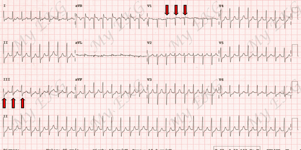 Eletrocardiograma de Taquicardia por reentrada nodal comum