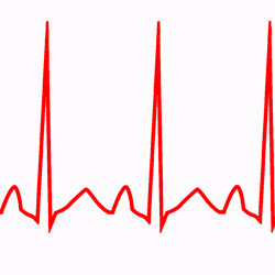 Inappropriate Sinus Tachycardia