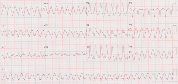 Monomorphic Ventricular Tachycardia Electrocardiogram