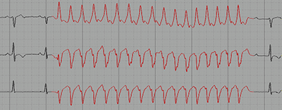 Non-Sustained monomorphic Ventricular Tachycardia