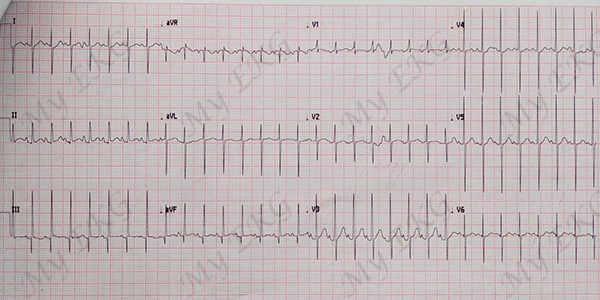 Électrocardiogramme de la tétralogie de Fallot