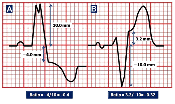 Third Modified Sgarbossa Criterion