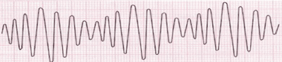 Électrocardiogramme de Torsades de Pointes.