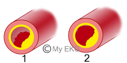 Tipos de Síndromes Coronarios Agudos