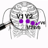 Tips for placing Electrocardiogram Electrodes