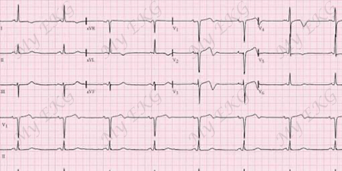 Electrocardiogram of Wellens syndrome type A