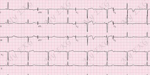 Eletrocardiograma da síndrome de Wellens tipo A